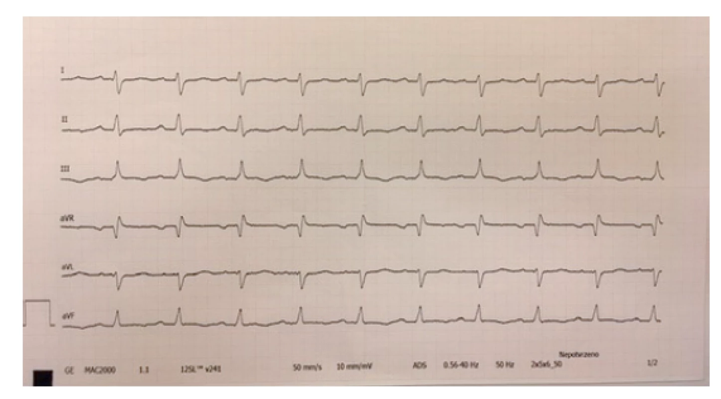 Změny repolarizační fáze – oploštělé až negativní
vlny T – standardní svody, zdroj vlastní