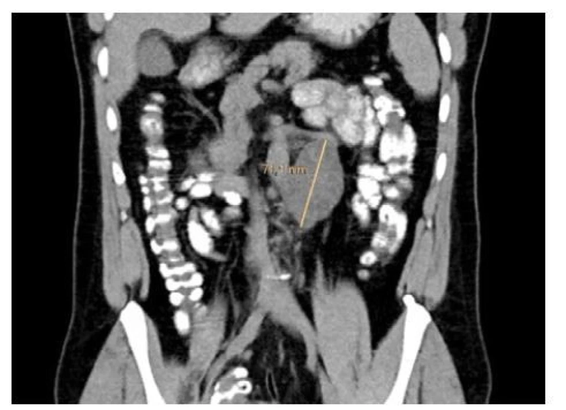 Progrese paketu uzlin retroperitonea<br>
Fig. 2. Progression of retroperitoneal lymph node
packet