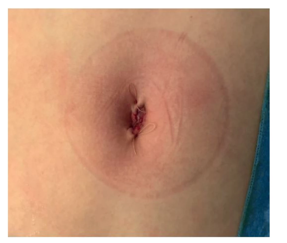 Operační rána na konci operačního výkonu<br>
Fig. 2: Surgical wound at the end of the operation