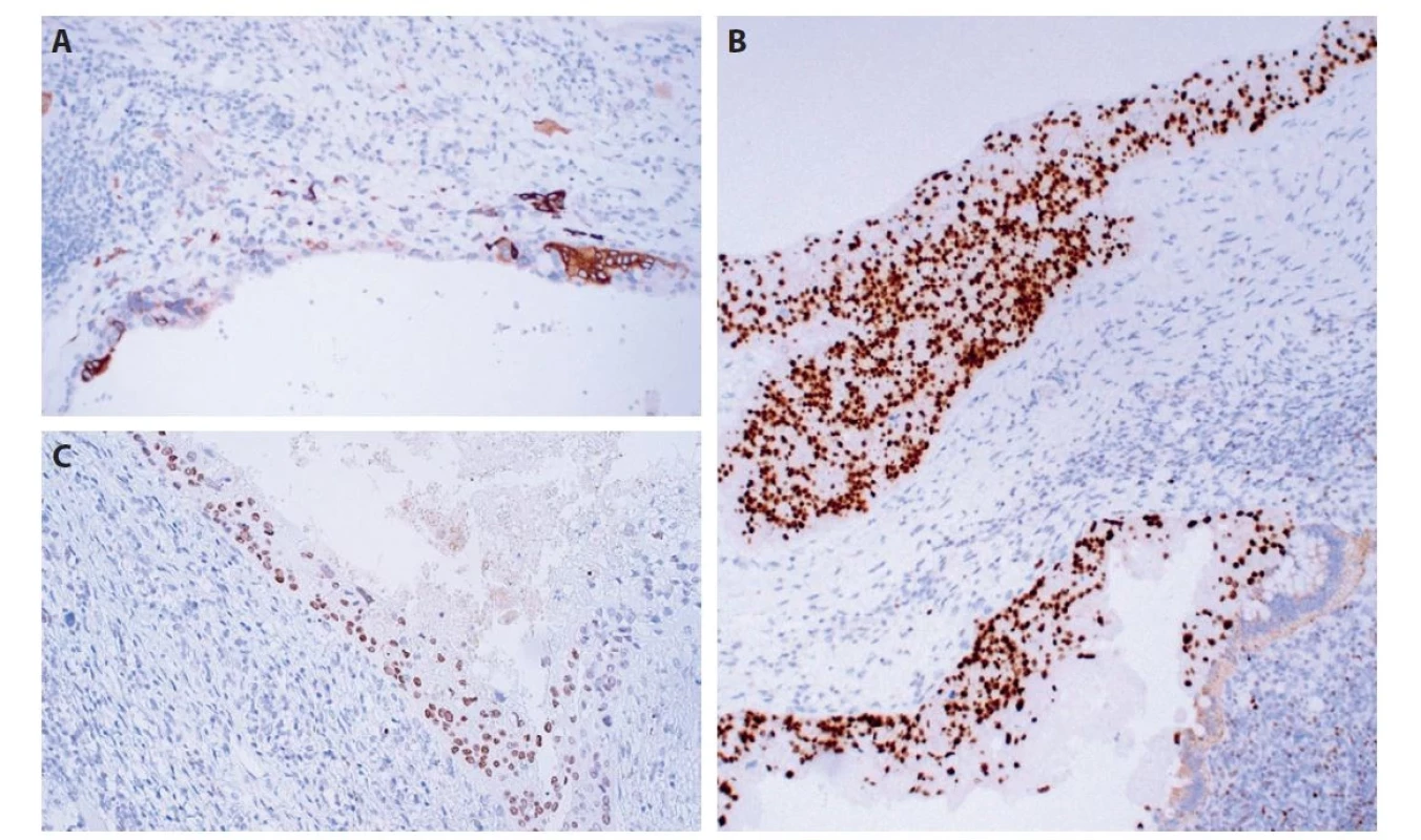 Imunohistochemické charakteristiky CTT: A - dôkaz ß-hCG v sporadických nádorových bunkách (zväčšenie x200); B - dôkaz GATA3 (zväčšenie
x200); C – dôkaz p63 (zväčšenie x100).