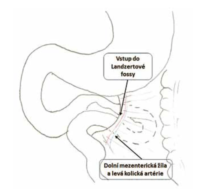 Schematické znázornění levostranné paraduodenální
kýly<br>
Fig. 1: Scheme of left paraduodenal hernia