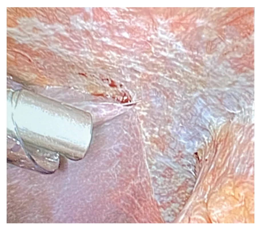 Capnopen v dutině břišní<br>
Fig. 6: Capnopen in the abdominal cavity