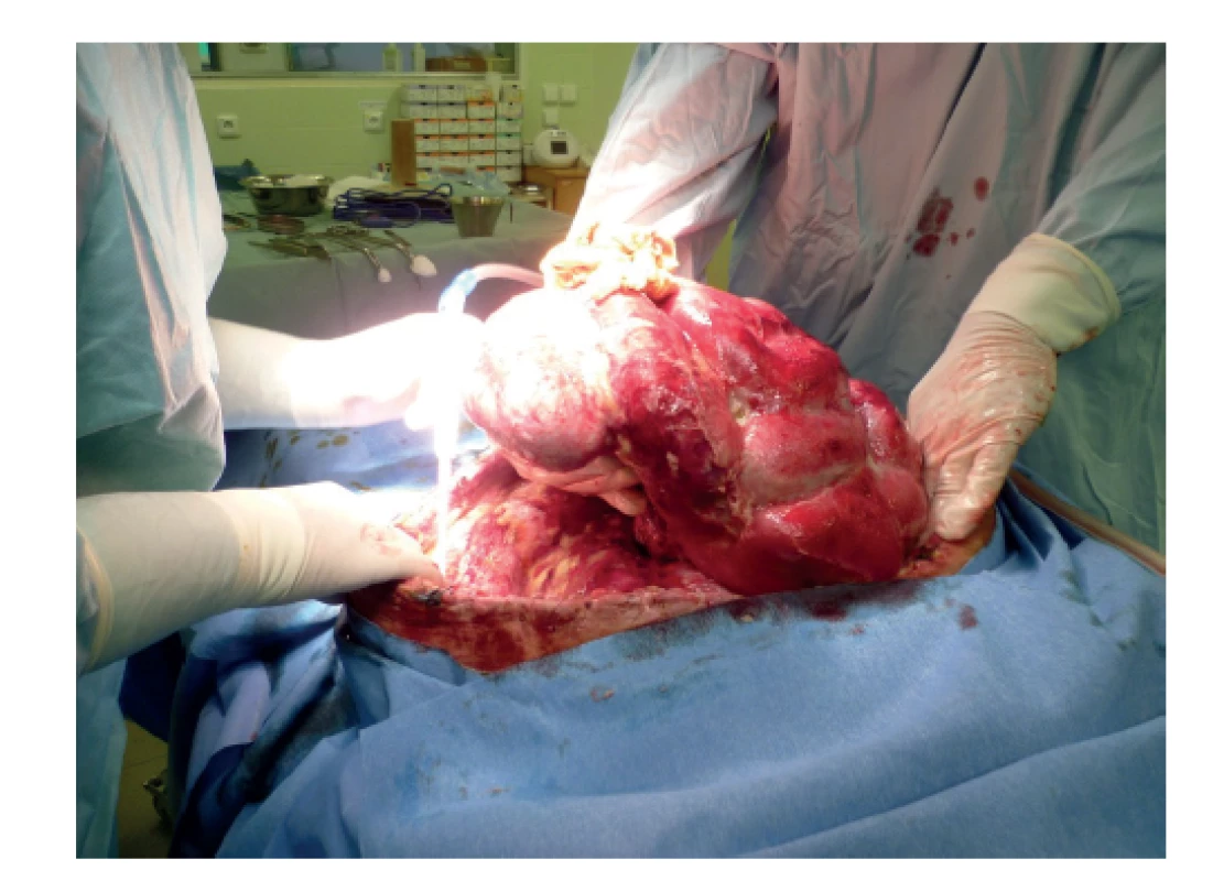 Ventrální kýla<br>
Fig. 1: Ventral hernia