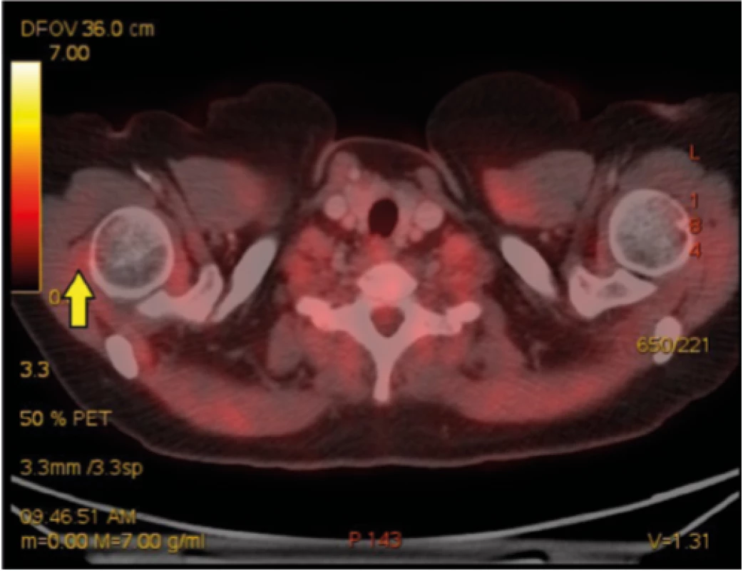 Radiologický obraz onemocnění – kazuistika 2