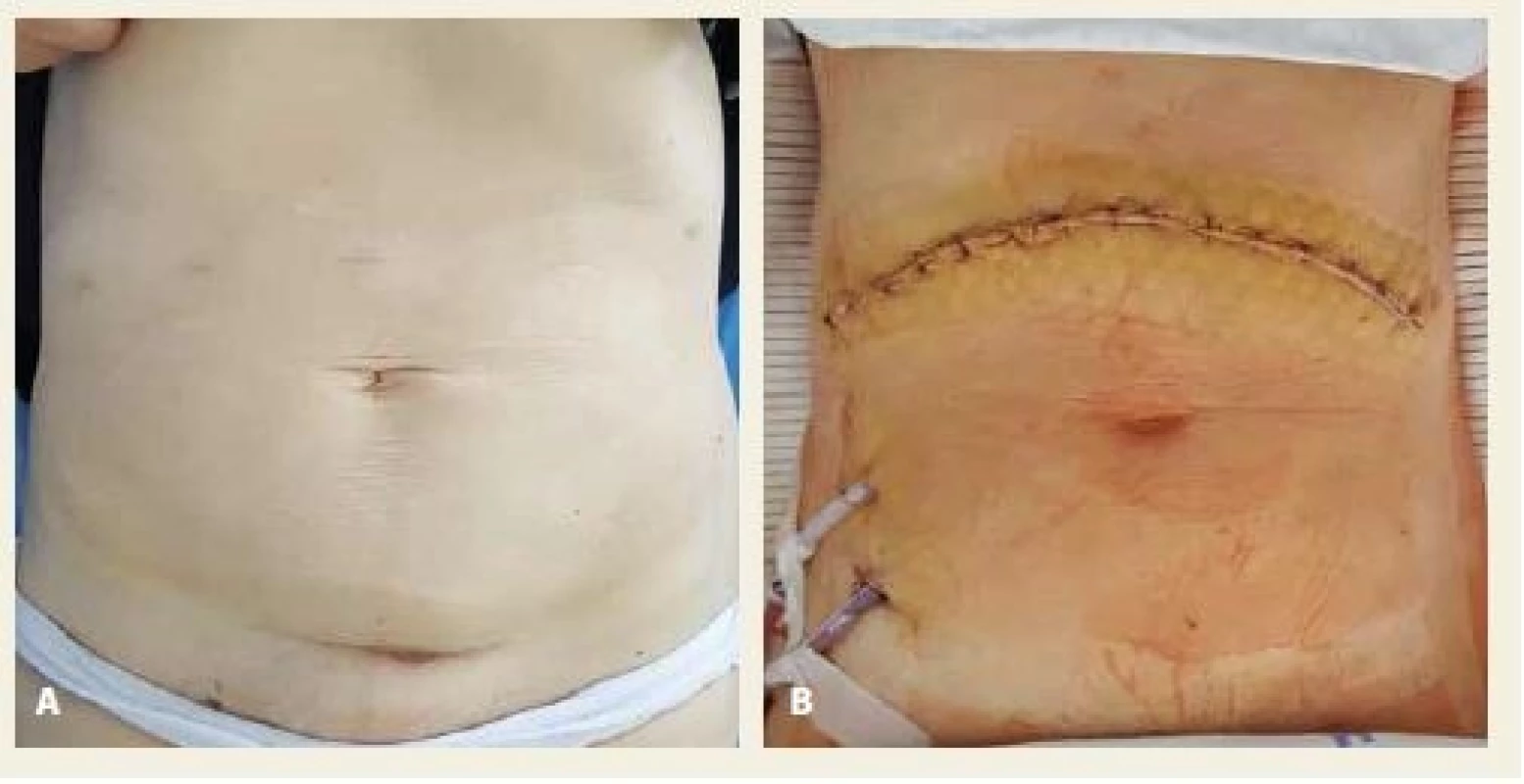 A, B. Comparison of cosmetic outcome in laparoscopic (A) and open (B)
pancreaticoduodenectomy.<br>
Obr. 4. A, B. Srovnání výsledného kosmetického efektu po laparoskopické (A)
a otevřené (B) pankreatoduodenektomii.