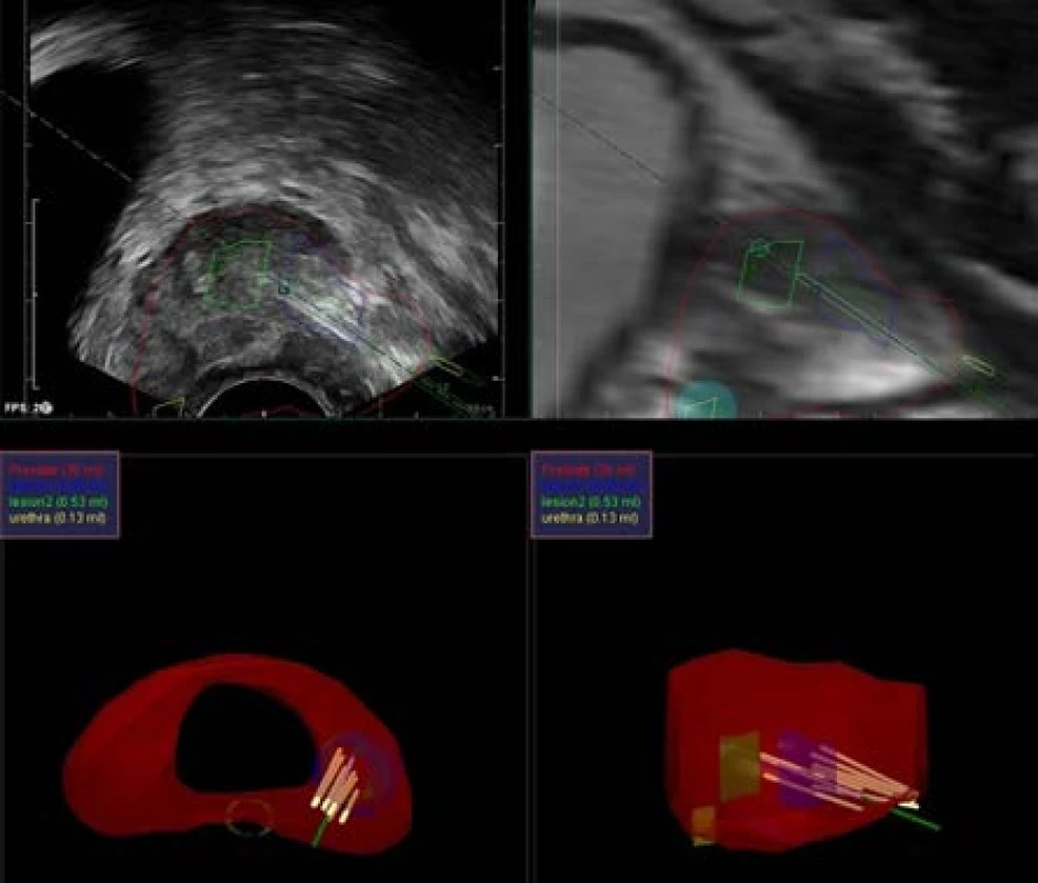 Cílená – MRI/TRUS softwarově navigovaná
biopsie prostaty<br>
Fig. 5. Targeted – MRI/TRUS software navigated
prostate biopsy