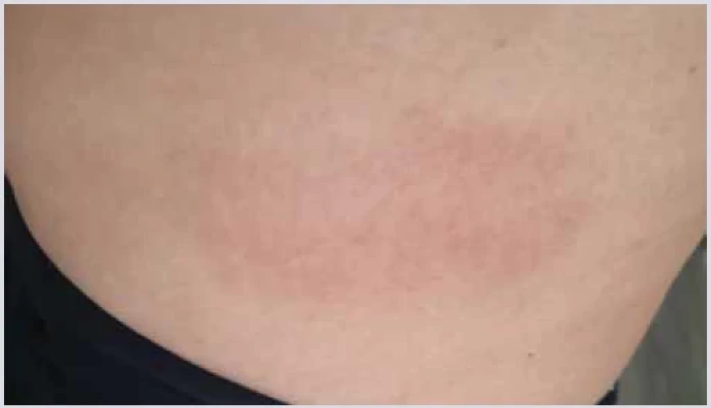 Reakce v místě vpichu. <br> 
Fig. 1. Injection site reaction.