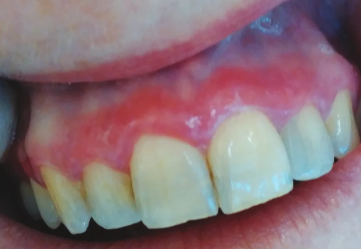 Deskvamativní gingivitida
v rámci orálního lichen
planus (z archivu autorky)
Fig. 1<br>
Desquamative gingivitis
in oral lichen planus
(author´s archive)