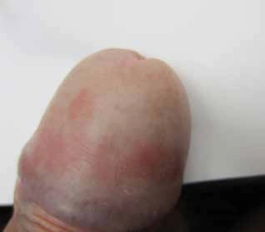 Atopická ekzém/dermatitida