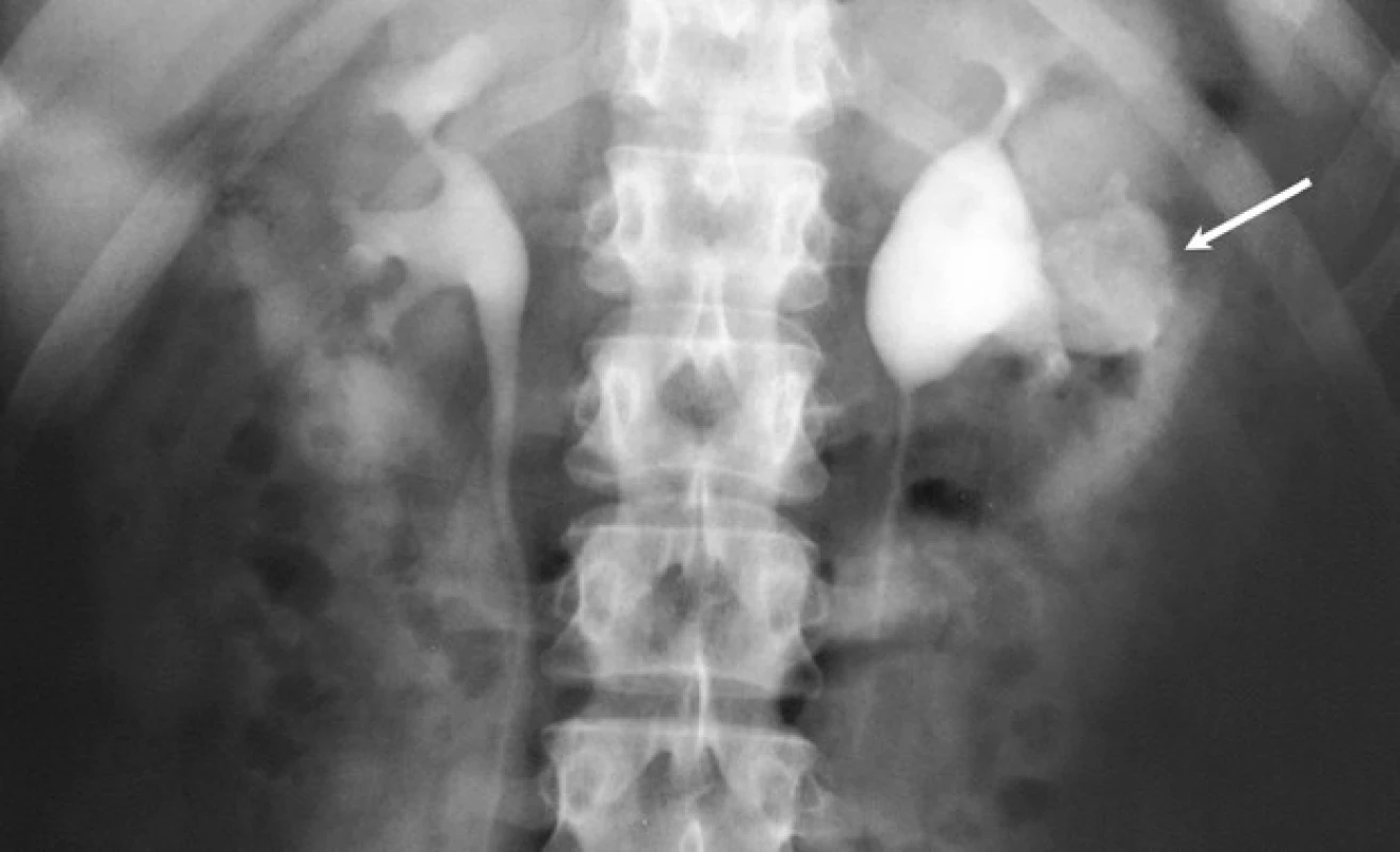 Vylučovací urografie:
kontrastní látkou se plnící TB kaverna
levé ledviny komunikující
s dutým systémem<br>
Fig. 1. Excretory urogram: contrast
agent is filling TB cavern that
communicates with the collecting
system of the left kidney