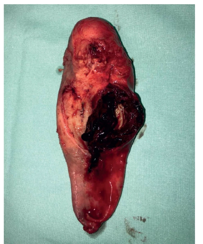 Rozstřižený žlučník s prokrvácenou stěnou s ložiskově
ulpívajícími koaguly<br>
Fig. 3: Cut gallbladder with perfused wall with adherent
coagulae