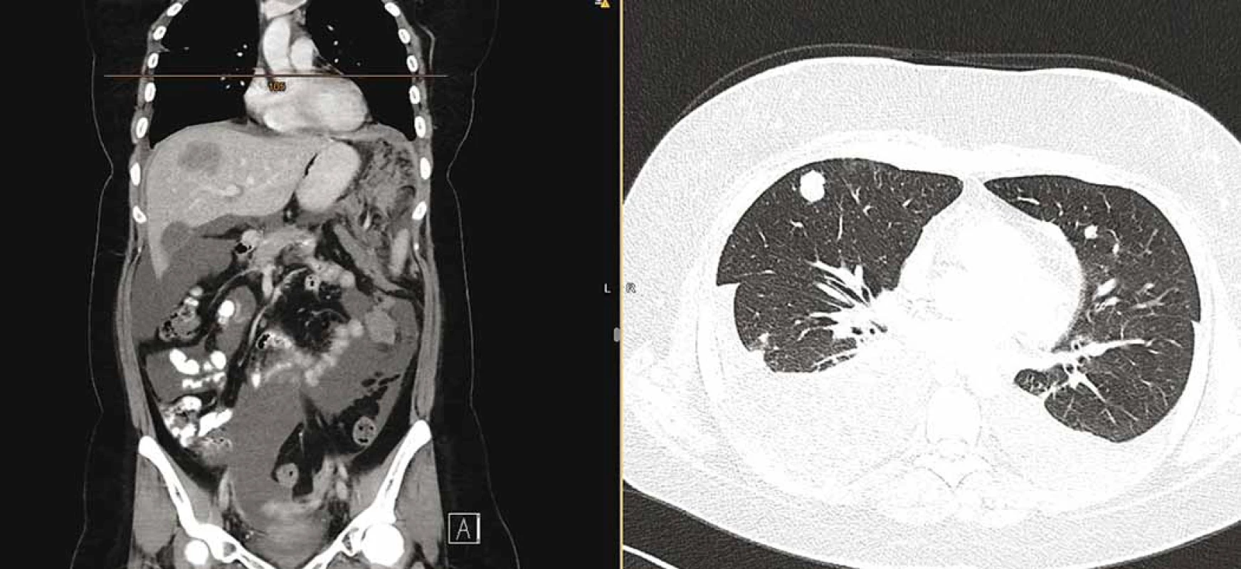 Snímek výpočetní tomografie trupu s potvrzenou parciální regresí nádoru v pánvi, nicméně masivní systémovou progresí
onemocnění se zvětšenými uzlinami na krku a v mediastinu, mnohočetným ložiskovým postižením plic a pleury s oboustranným
fluidothoraxem, vícečetným ložiskovým postižením jater (největší 52 × 36 mm), postižením omenta s měkkotkáňovými masami
(největší 72 × 56 mm) a ascitem.
