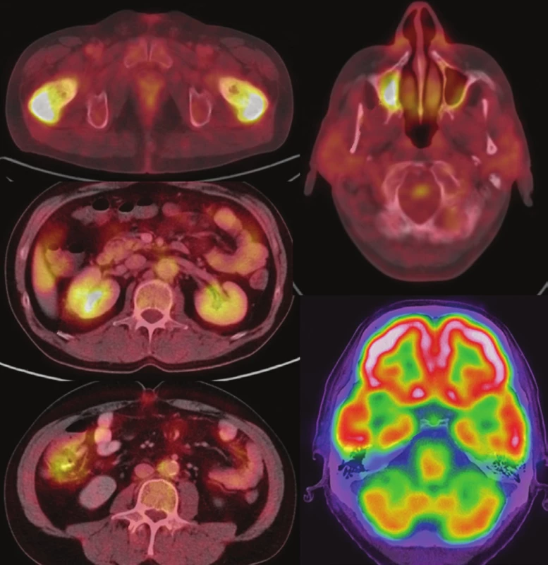 Sumarizace nálezů <sup>18</sup>F-FDG PET/CT vyšetření u pacienta č. 1. Černobílé
MIP projekce ukazují jednak rozsah snímání, ale zároveň dobře odráží
i rozsah kostního postižení. Fúzované obrazy v axiální rovině pak ukazují detaily
kostního, paranasálního, retroperitoneálního, kardiovaskulárního i hypofyzárního
postižení