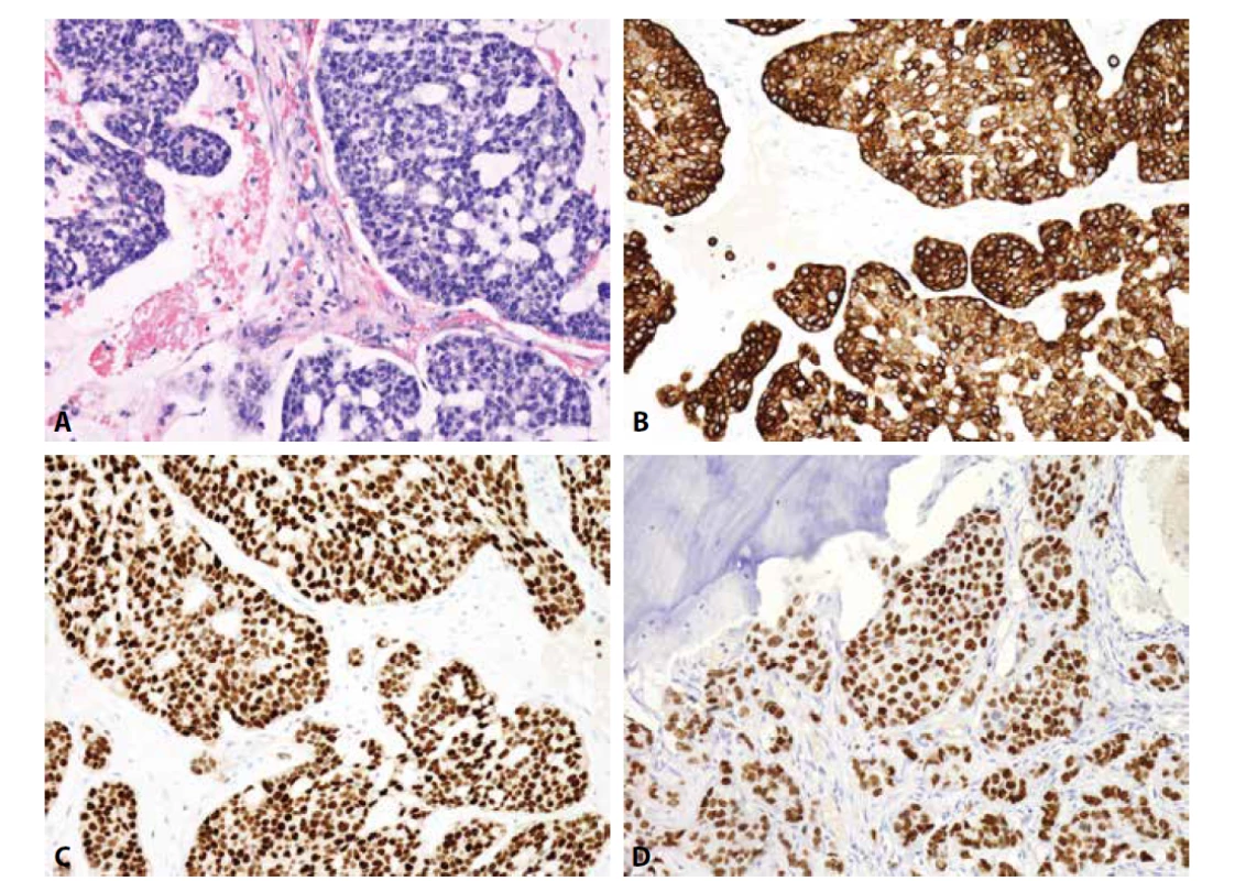 Metastáza karcinomu mammy. A) kribriformní formace (H&E); B) cytoplazmatická exprese CK7, C) jaderná exprese ER, D) jaderná exprese
GATA3 (vše zvětšení x200).