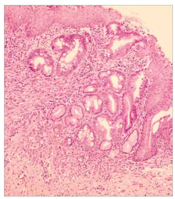 Histopatologický obraz gastrického choristomu 2.
Barvení hematoxylin-eozin, zvětšení 20x. Na preparátu
jsou detailněji zachycena místa přechodu žaludečního
epitelu v intestinální metaplazii, jež je známým prekurzorem
adenokarcinomu.<br>
Fig. 5. Histopathological picture of gastric choristoma 2. Hematoxylin-
eosin staining, magnification 20x. The preparation
shows in more detail the sites of gastric epithelial transition
in the intestinal metaplasia, which is a known precursor
of adenocarcinoma.
