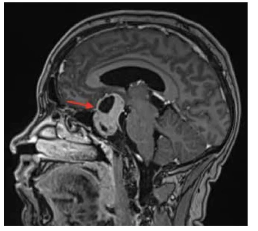 MR mozgu T1-viazaný sagitálny scan zobrazuje solídne-
cystický tumor hypofýzy tvaru orecha, veľkosti 43x30 mm,
vychádza zo sedla a šíri sa supraselárne