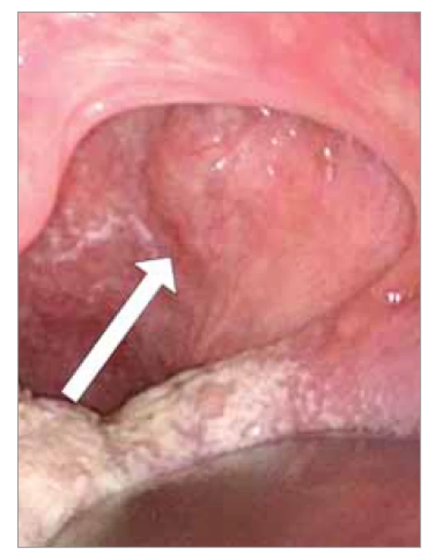 Pulzující vyklenutí zadní stěny
orofaryngu.<br>
Fig. 7. Pulsating arching of the posterior
wall of the oropharynx.