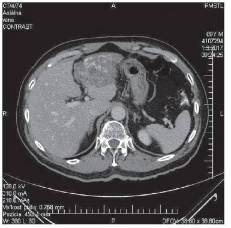 CT − venózna fáza, axiálny<br>
Fig. 2: CT − venous phase, axial