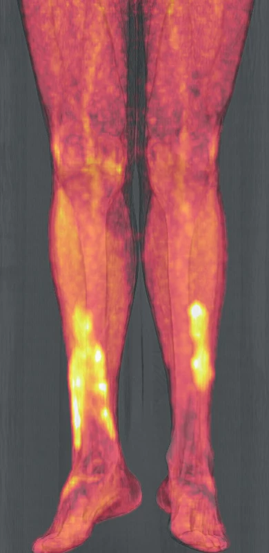 PET/CT zobrazení dolních končetin pacienta s xantogranulomem
z roku 2019 – část 2