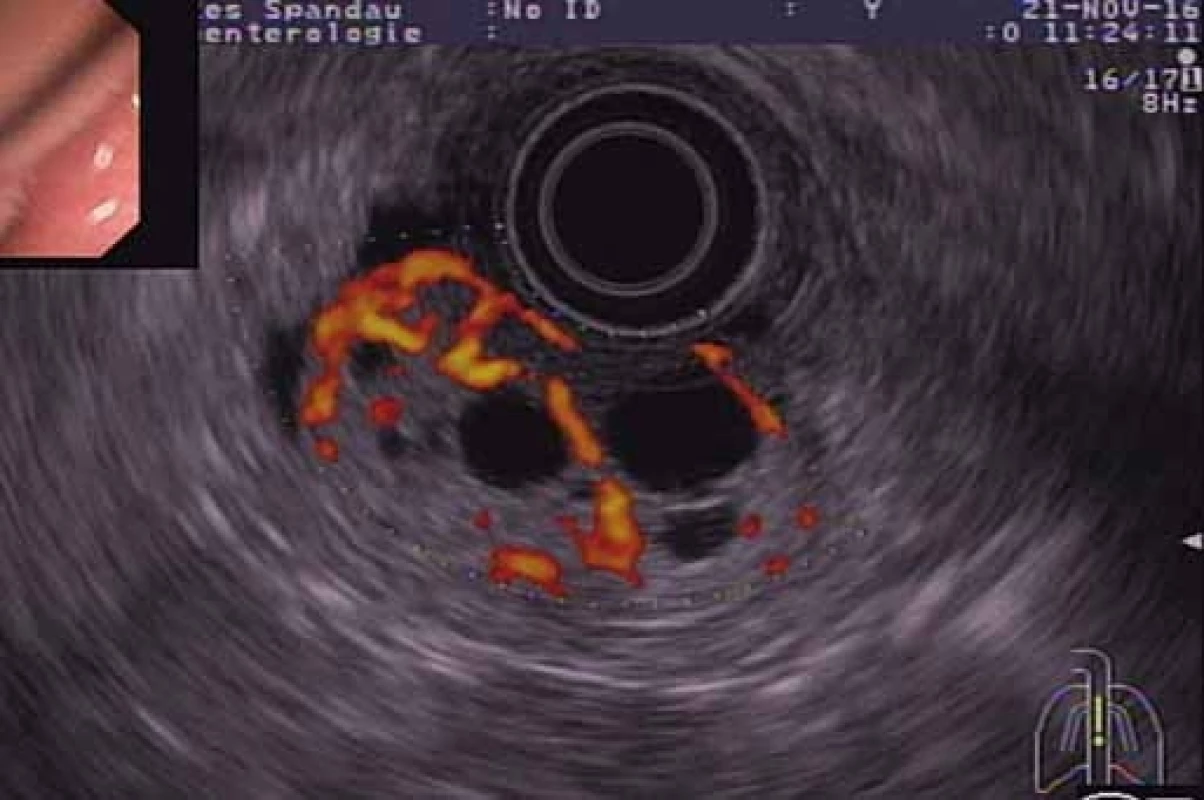 EUS s použitím farebného Dopplera – bohatá vaskularizácia nádoru.<br> Fig. 4. EUS with a colour Doppler – high vascularisation of the tumour.