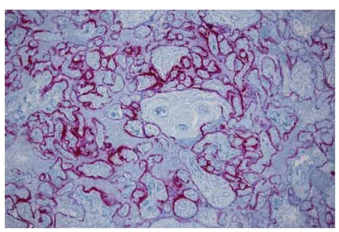Imunohistochemický průkaz nukleokapsidového proteinu viru
SARS-CoV-2 v cytoplasmě vilózního trofoblastu (SARS2 – BioSB, 100x).<br>
Fig. 6. Immunohistochemical detection of SARS-CoV-2 nucleocapsid protein in cytoplasm
of a villous trophoblast (SARS2 – BioSB, 100x).