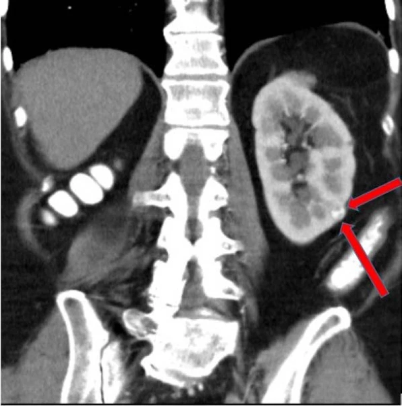 Tumor v oblasti levé ledviny dle
CT zobrazení z druhé poloviny května
2016<br>
Fig. 1. Tumor in the left kidney – CT
May, 2016