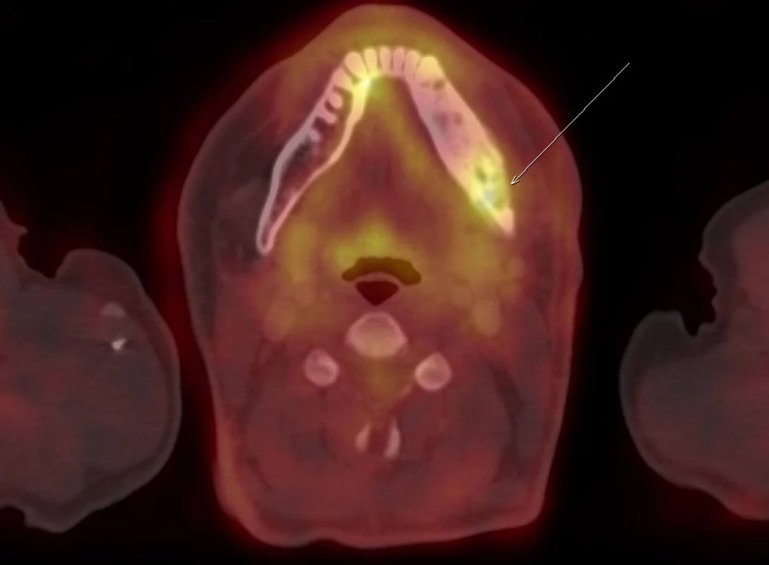 FDG-PET/CT zobrazení dolní čelisti. Patologický proces v dolní čelisti akumuluje FDG (a podobně i jiná radiofarmaka vcelku) ochotně. Dle FDG-PET/CT však
nelze rozlišit fibrózní dysplazii od jiných kostních (nádorových) patologií. V tomto případně bylo prokázáno jen toto jediné izolované kostní ložisko v mandibule