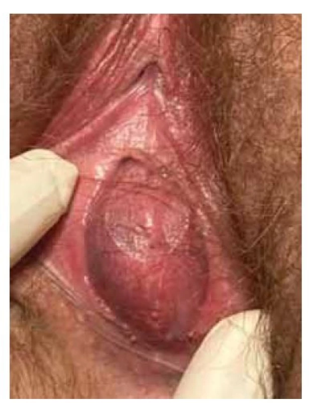 Atrezie hymenu.<br>
Fig. 3. Hymenal atresia.