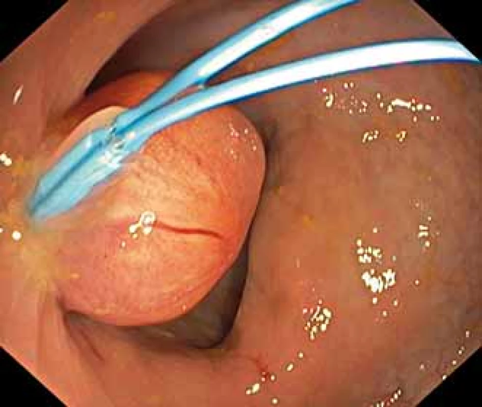 Lipom rekta velikosti asi
20 × 15 mm s nasazeným endoloopem.
Fig. 1. Rectal lipoma about 20 × 15 mm
in size with endoloop attached.