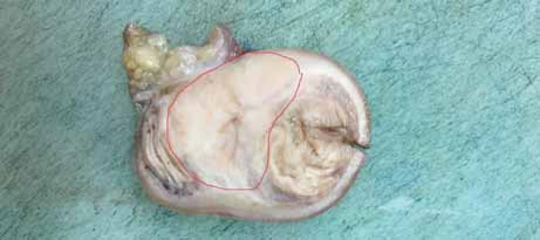 Makrofotografie tenkého střeva s tumorem na řezu, nádorová infiltrace
označena červeně.<br>
Fig. 2. Macrophotography of small bowell with tumor on section, tumor infiltration
marked in red.