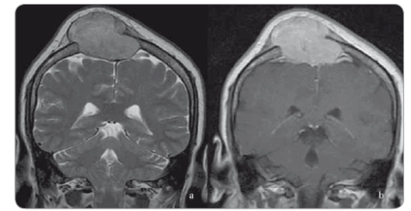 Coronal T2-weighted fast spin echo and sagittal contrast enhanced T1-weighted
MRI images show a calvarial expansile lytic lesion located at the right paramedian
frontoparietal region with an intense heterogenous contrast enhancement. There is
also compression and displacement of superior sagittal sinus without any finding of dural
invasion.