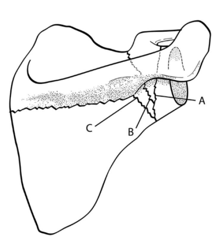 Goss´s classification of scapular neck fractures.
A – fracture of anatomical neck, B – fracture of surgical
neck, C − fracture of neck inferior to scapula spine (Figure
adapted from Goss, Ref. [6]).