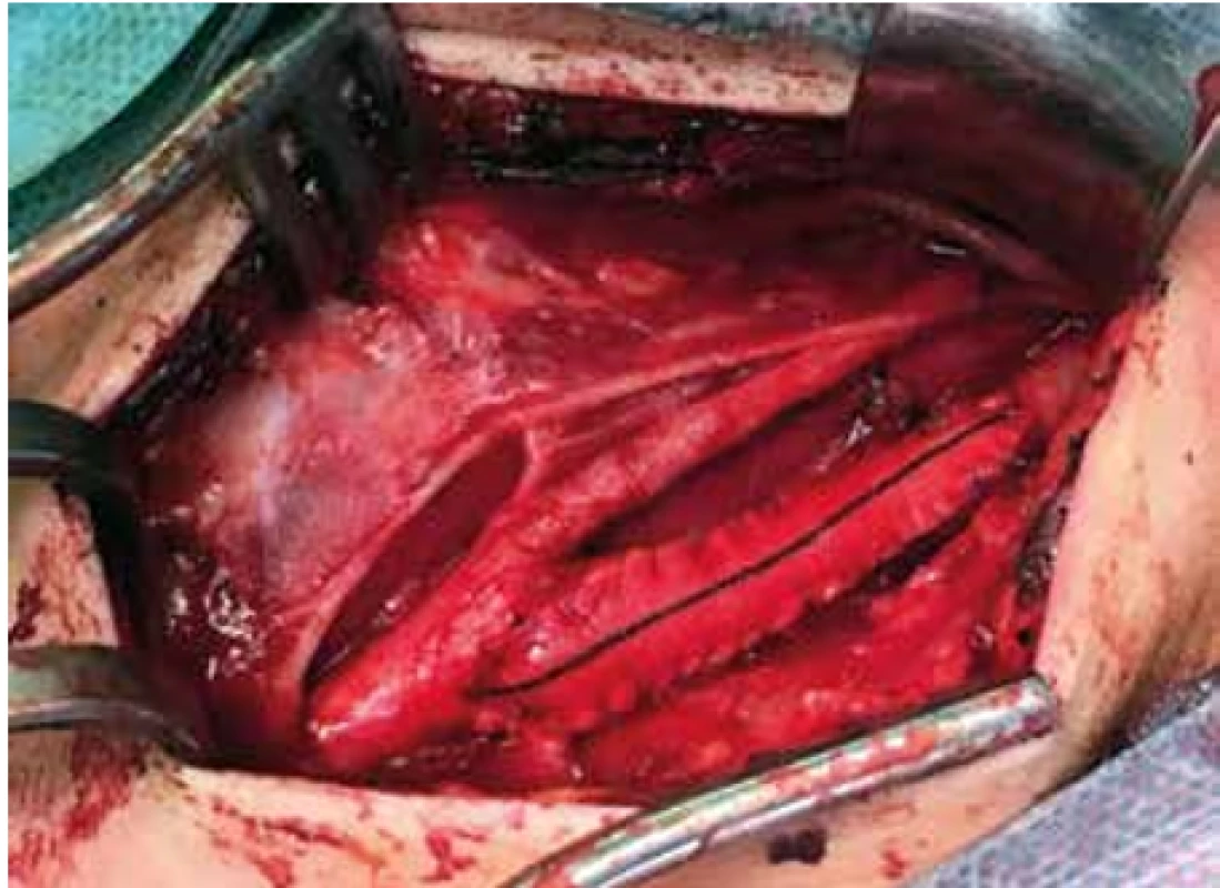 Uzávěr rekanalizované ACI protetickým patchem  <br>
Fig. 4. Closure of recanalized ACI with a prosthetic patch