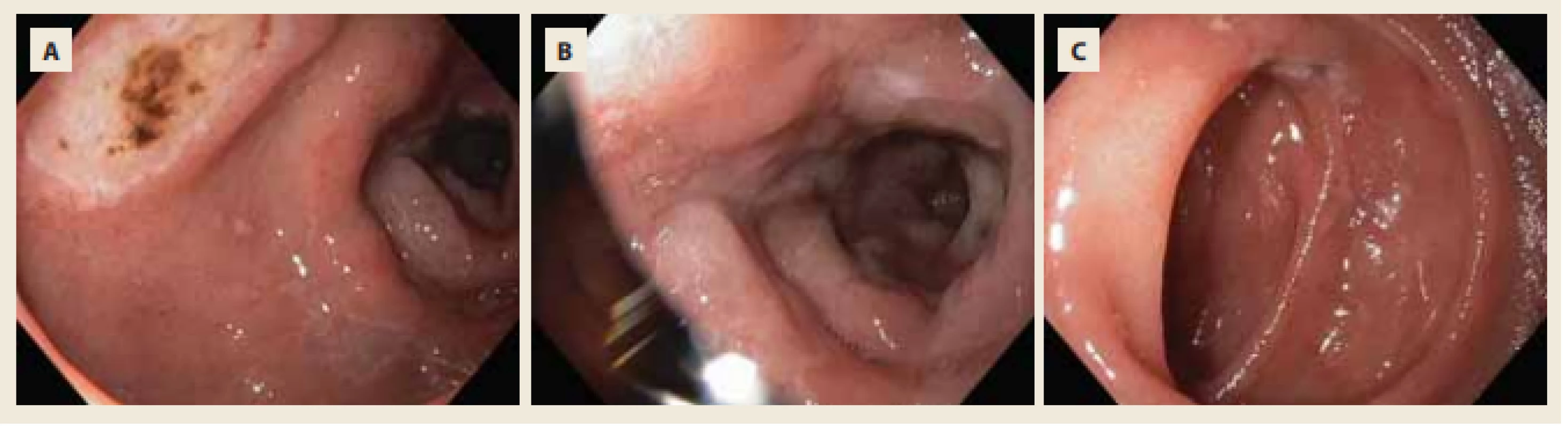 Mnohočetné akutní vředy bulbu a D2 duodena charakteru Forrest IIc a III. <br>
Fig. 3. Multiple acute ulcers of duodenal bulb and D2 duodenum – Forrest IIc and III. 