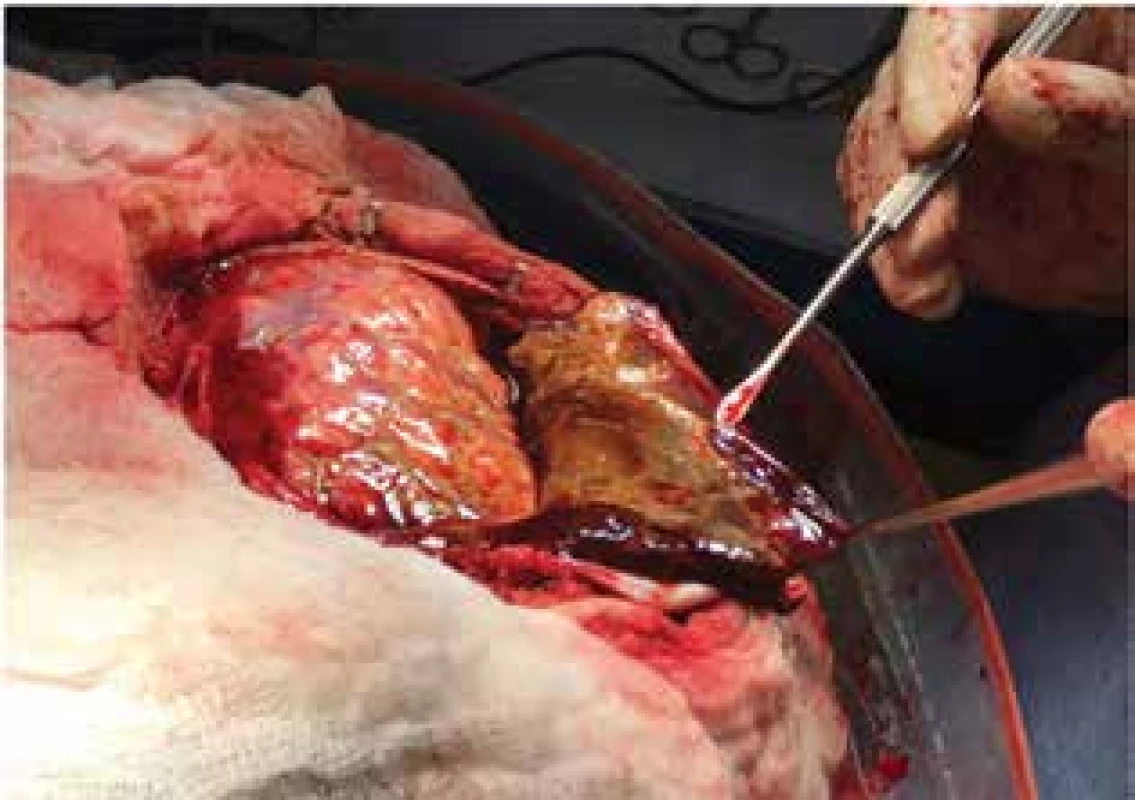 Resekce septovaného, tuhého chronického
hematomu, který nebylo možné vypustit z návrtu<br>
Fig. 3: Resection of multilobulated chronic subdural
hematoma through a craniotomy, which was not
possible to evacuate through a burr hole