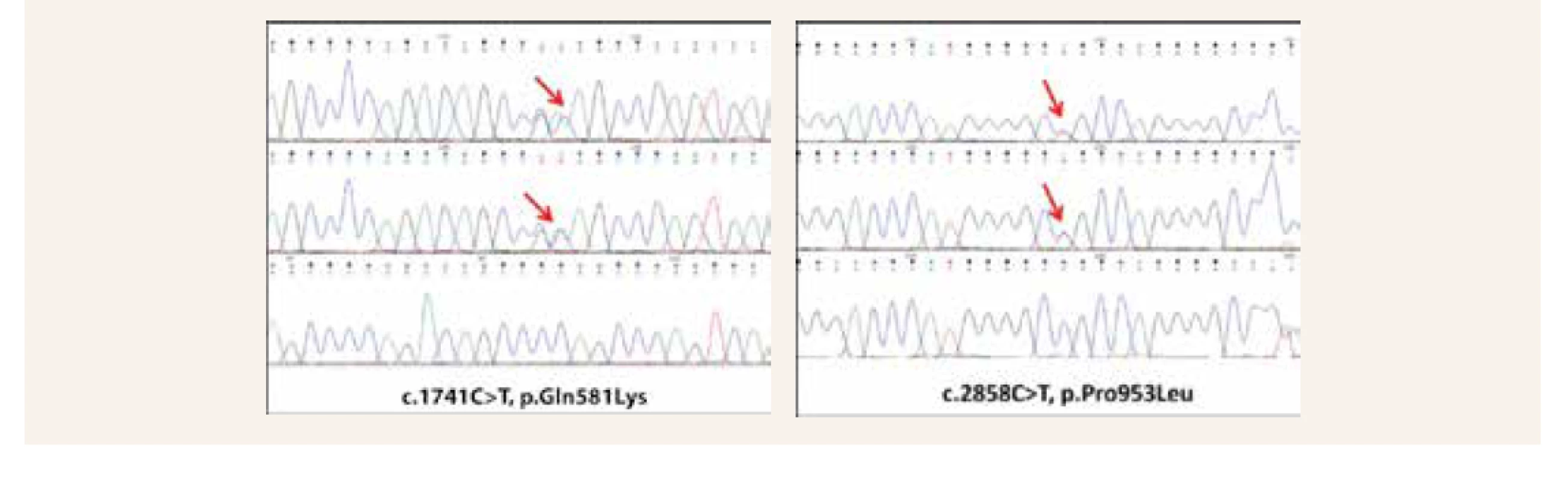 Segregačná analýza identifikovaných genetických variantov prostredníctvom Sangerovho sekvenovania
(Chromas). Variant c.1741C>T zdedila probandka po otcovi a variant c.2858C>T po matke