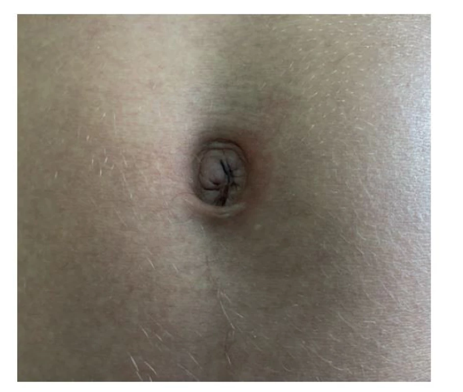 Jizva v pupku za 6 týdnů po operaci<br>
Fig. 7: Scar in the umbilicus 6 weeks after surgery