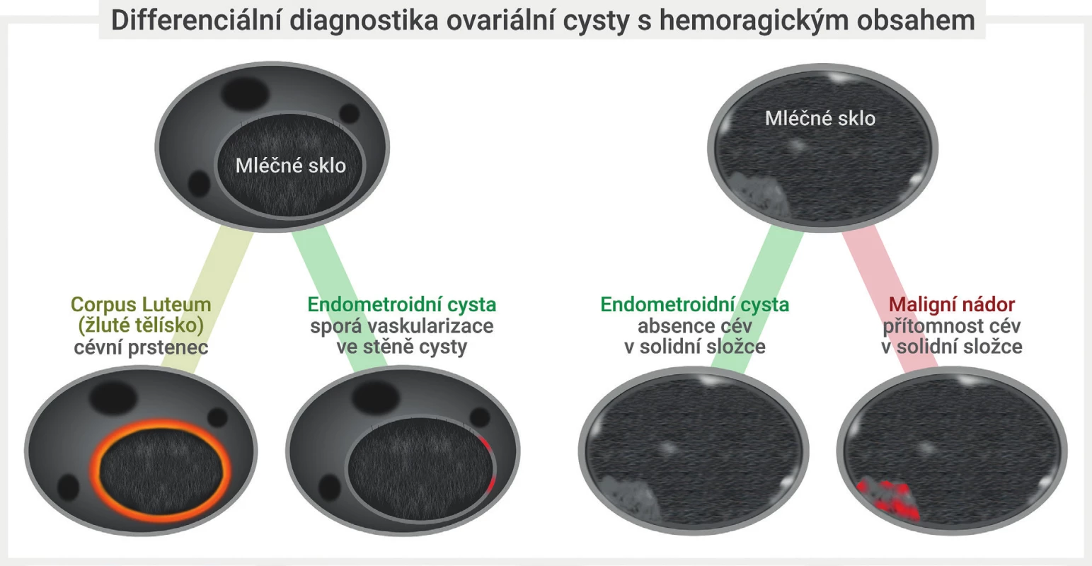 Diferenciální diagnostika hemoragické ovariální cysty<br>
Unilokulární cysta s intracystickou tekutinou vzhledu mléčného skla s cévním hypervaskulárním lemem v zobrazení barevným dopplerem svědčí
pro přítomnost funkční korpusluteinní hemoragické cysty, přítomnost sporé perfuze v pouzdru perzistující unilokulární cysty s tekutinou vzhledu
mléčného skla svědčí nejspíše pro endometroidní cystu. Detekce přítomnosti cév uvnitř intracystické hyperechogenní papilární prominence je
vhodná k odlišení krevního (avaskulárního) koagula od nádorové (vaskularizované) papilární prominence, která je charakteristickým nálezem
ovariálních borderline nádorů. Obrázek modifikován z Guerriero et al [7].