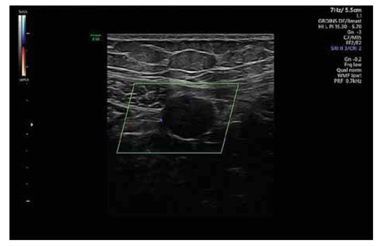 Ultrazvukový nález parazitárního leiomyomu uloženým retroperitoneálně
mezi přímým a šikmým svalem břišním.<br>
Fig. 3. Ultrasound finding of parasitic leiomyoma located retroperitoneally
between the rectus abdominus and the oblique abdominal muscle.