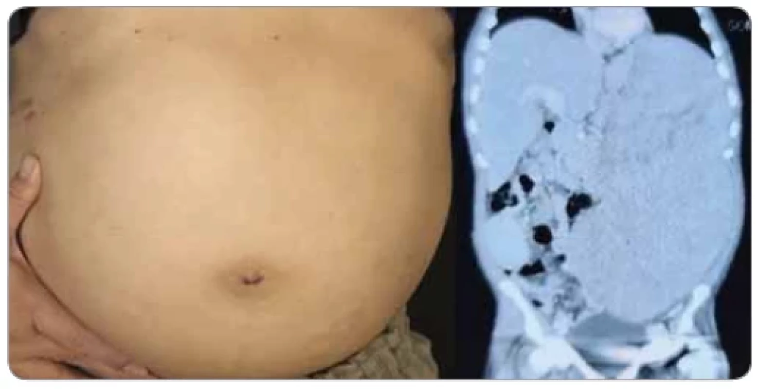 Clinical examination and abdominal CT-scan showing massive splenomegaly.