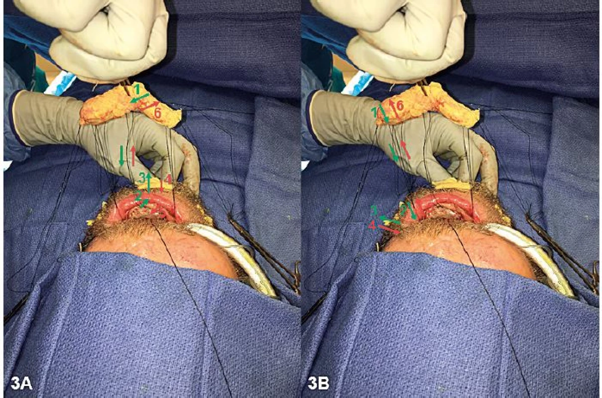 Scheme of the sequence of suture placement to secure the intraoral bolster. Schematic view of suture placement to secure the
intraoral bolster. Green text/arrows depict the entry route of the sutures, and red text/arrows depict the exit route of the sutures.
(A) The anterior sutures were run (1) through the Xeroform bolster, (2) through the graft in the anterior floor of the mouth, and (3)
through the mentolabial sulcus (superior to the reconstructed osseous mandible) and an external piece of Xeroform. The suture was
then run in the reverse direction: (4) through the external Xeroform and mentolabial sulcus, (5) through the graft in the anterior floor of
the mouth, and (6) through the Xeroform bolster. (B) Similarly, the lateral sutures were run (1) through the Xeroform bolster, (2) through
the graft in the lateral floor of the mouth, and (3) through the lateral cheek (superior to the reconstructed osseous mandible) and an
external piece of Xeroform. The suture was then run in the reverse direction: (4) through the external Xeroform and lateral cheek, (5)
through the graft in the lateral floor of the mouth, and (6) through the Xeroform bolster