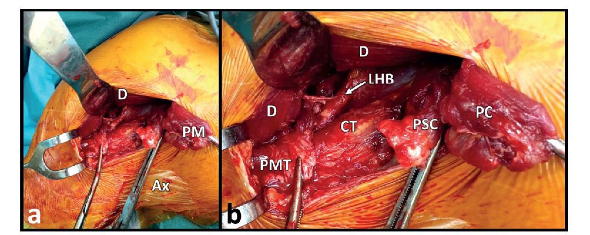Peroperační nález akutní kompletní ruptury obou porcí šlachy m. pectoralis major<br>
Fig. 5: Intraoperative finding of acute complete rupture of both portions of the pectoralis major rendon