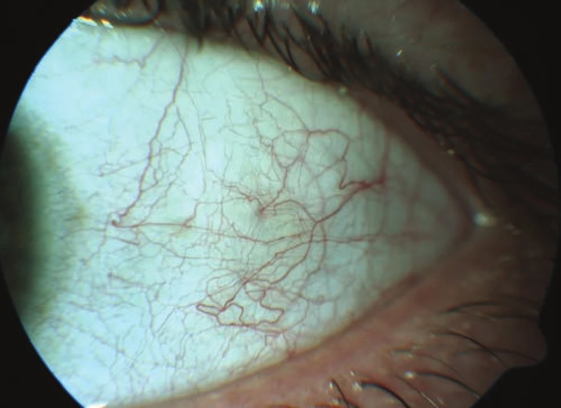 HIV microvasculopathy of the anterior segment of the eye -
vascular tortuosity, intermittent blood flow, microaneurysms
