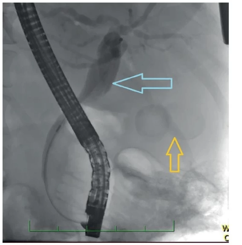 ERCP zobrazující dilataci dc. choledochus (modrá
šipka), dva objemné konkrementy ve žlučníku (žlutá šipka)<br>
Fig. 2: ERCP showing the dilatation of the common bile
duct (blue arrow) and two massive stones in the bladder
(yellow arrow)