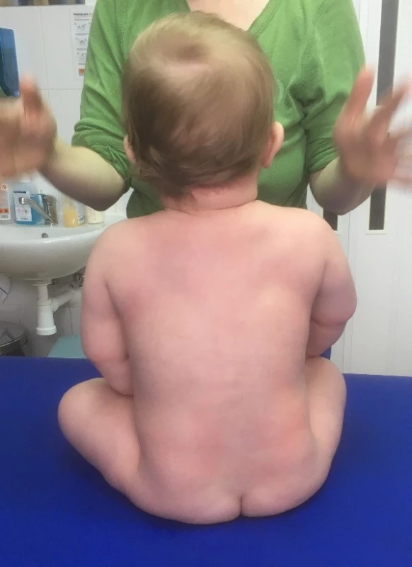 Věk 7 měsíců, ve volném sedu chlapec častěji zatěžuje více levou hýždi, pravý ramenní pletenec je v lehké elevaci, PHK ve větší protrakci a vnitřní rotaci.<br>
Fig. 9. Age 7 months, in a free sitting position, the boy more often burdens the more left buttock, the right shoulder girdle is in a slight elevation, the right upper limb in the greater protraction and internal rotation.