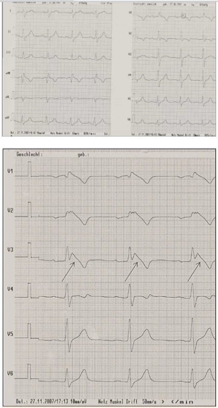  Syndrom Brugadových. <br>
5A. Nativní EKG křivka <br>
5B.  Po provokaci ajmalinem: vznik Brugada obrazu typu I (šipky)