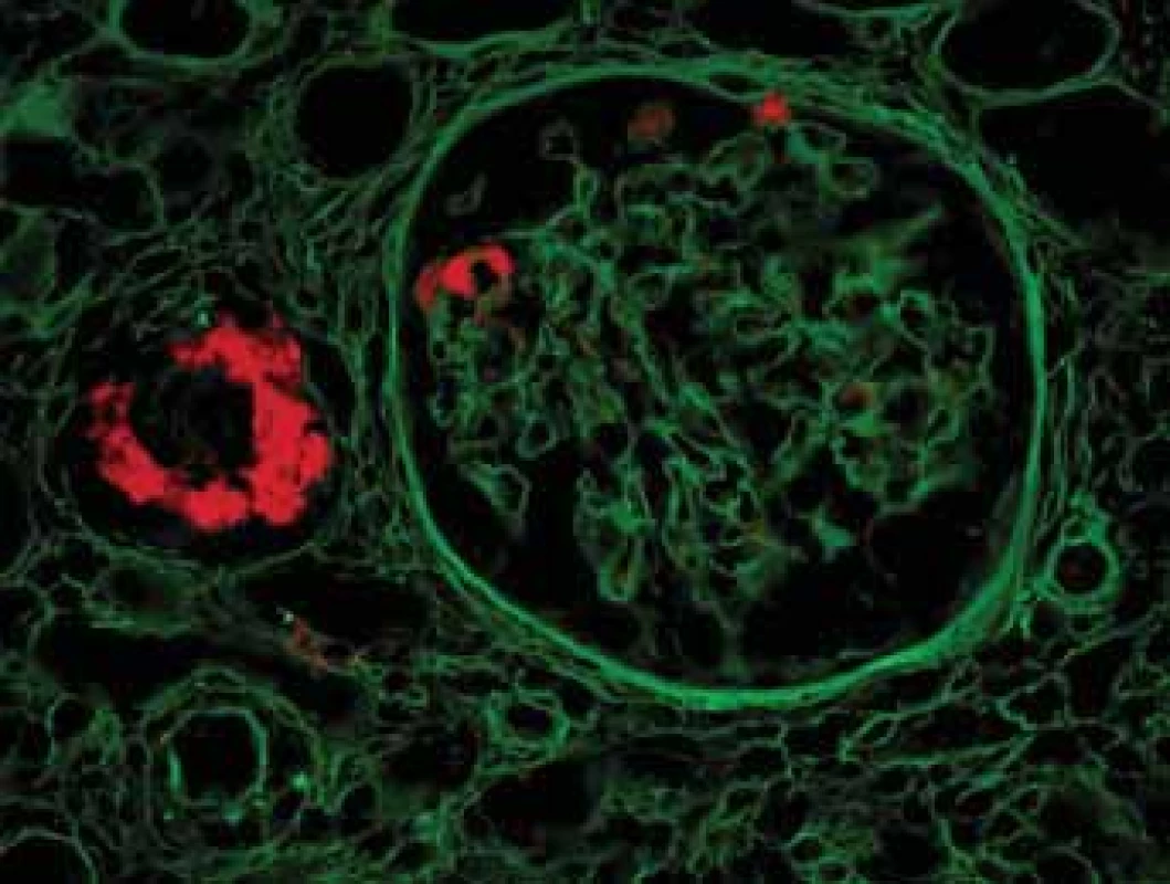 Histologické nálezy u pacientů s IBD a renálnímmpostižením (tubulointersticiální nefritida, glomerulonefritida, AA amyloidóza). Autofluorescence Kongo červeně detekuje objemné depozitum ve stěně cévy a malá depozita v glomerulu.<br>
Fig. 10. Biopsy pictures in IBD patients with renal
illness (tubulointerstitial nephritis, glomerulonephritis,
AA amyloidosis). Autofluorescency of Kongo red shows bulky
deposit in vessel wall and small deposits in glomerulus.