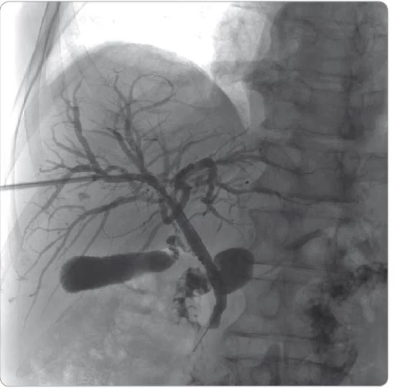 Cholangiografie přes perkutánní transhepatický drén po léčbě kortikosteroidy.