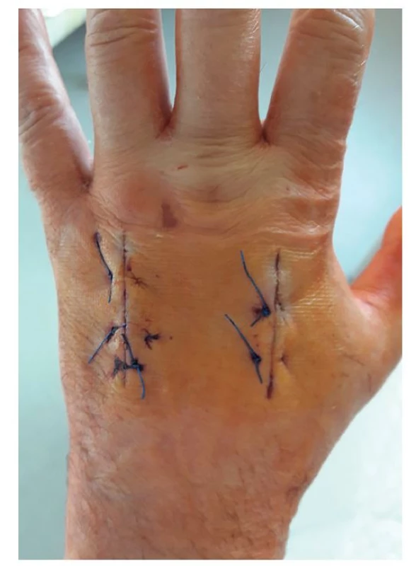 Levá ruka, dorzum, 8. pooperační den<br>
Fig. 8: Left hand, dorsal part, postoperative day 8