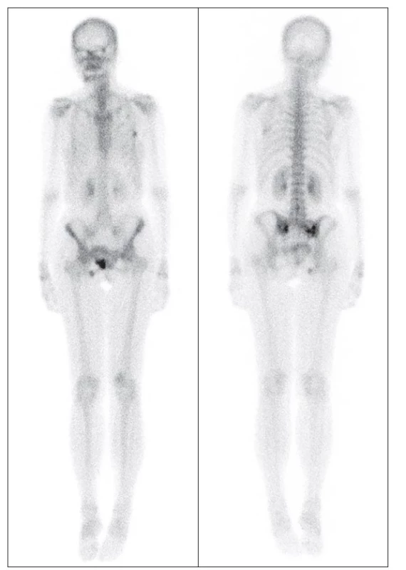 Celotělový snímek kostní fáze třífázové scintigrafie skeletu v přední
a zadní projekci. Zvýšená akumulace aktivity v oblasti pravé lopaty kyčelní
a SI skloubení. Dále je viditelná zvýšená kostní přestavba v horním raménku
kosti stydké vpravo jakožto hojící se fraktura po pádu.